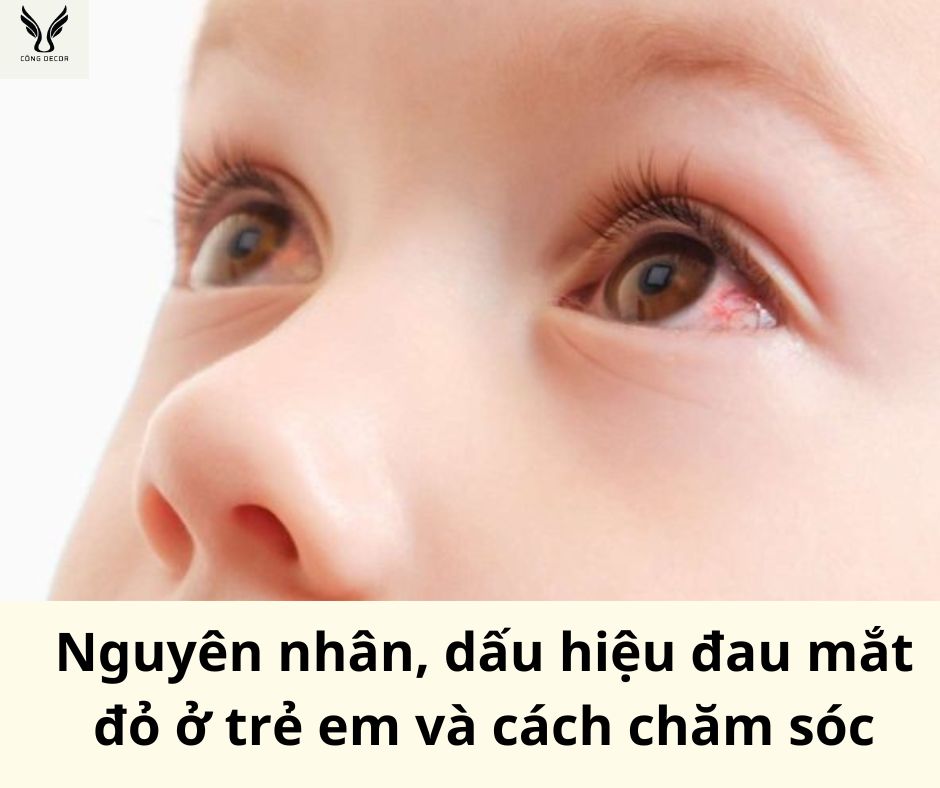 Nguyên nhân, dấu hiệu đau mắt đỏ ở trẻ em và cách chăm sóc